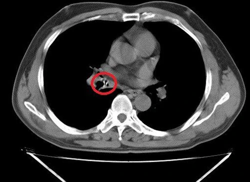 Mảnh xương gà mắc trong phế quản cụ ông