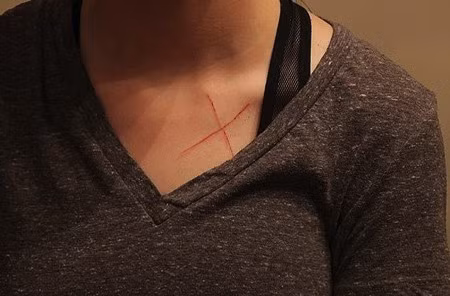 thanh nien suyt di tu 99 nam vi bi to khac chu x len nguc bo cu hinh anh 1