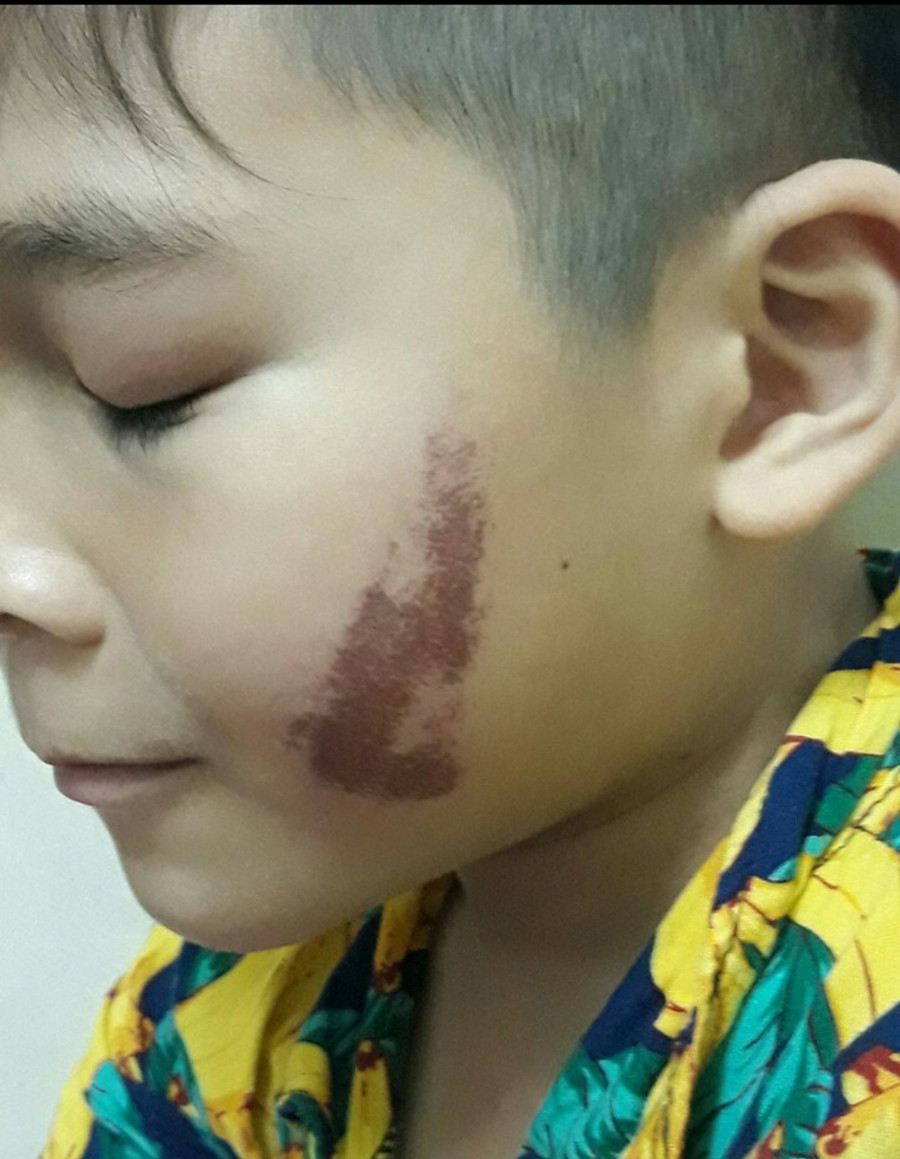 Vết thâm ở má em B. sau nhiều ngày nằm viện. Ảnh phụ huynh cung cấp Vết thâm ở má em B. sau nhiều ngày nằm viện. Ảnh phụ huynh cung cấp