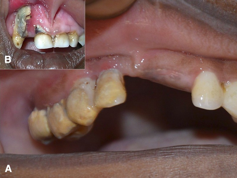 Noma - Căn bệnh kinh hoàng nhất thế giới, chỉ có 15% trẻ em sống sót ảnh 1