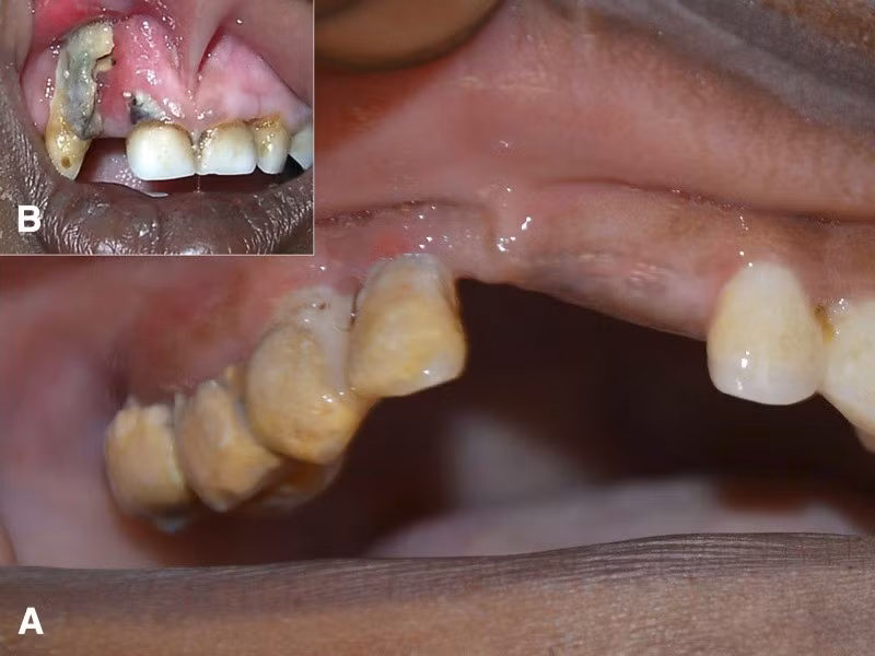 Noma - Căn bệnh kinh hoàng nhất thế giới, chỉ có 15% trẻ em sống sót ảnh 1 Noma - Căn bệnh kinh hoàng nhất thế giới, chỉ có 15% trẻ em sống sót ảnh 1