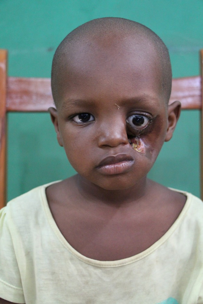 Noma - Căn bệnh kinh hoàng nhất thế giới, chỉ có 15% trẻ em sống sót ảnh 2