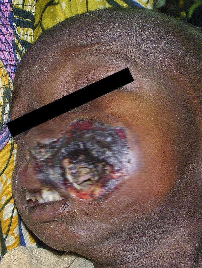 Noma - Căn bệnh kinh hoàng nhất thế giới, chỉ có 15% trẻ em sống sót sau cơn đau cấp tính - Ảnh 3.