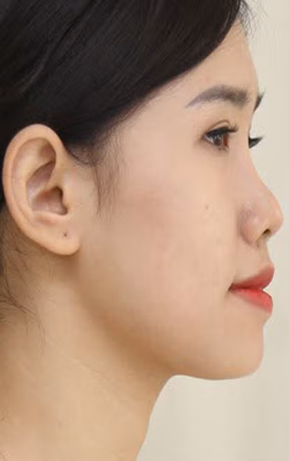 Mũi tẹt là sống mũi thấp, hơi cong nhẹ, được coi là một trong những tướng mũi xấu.