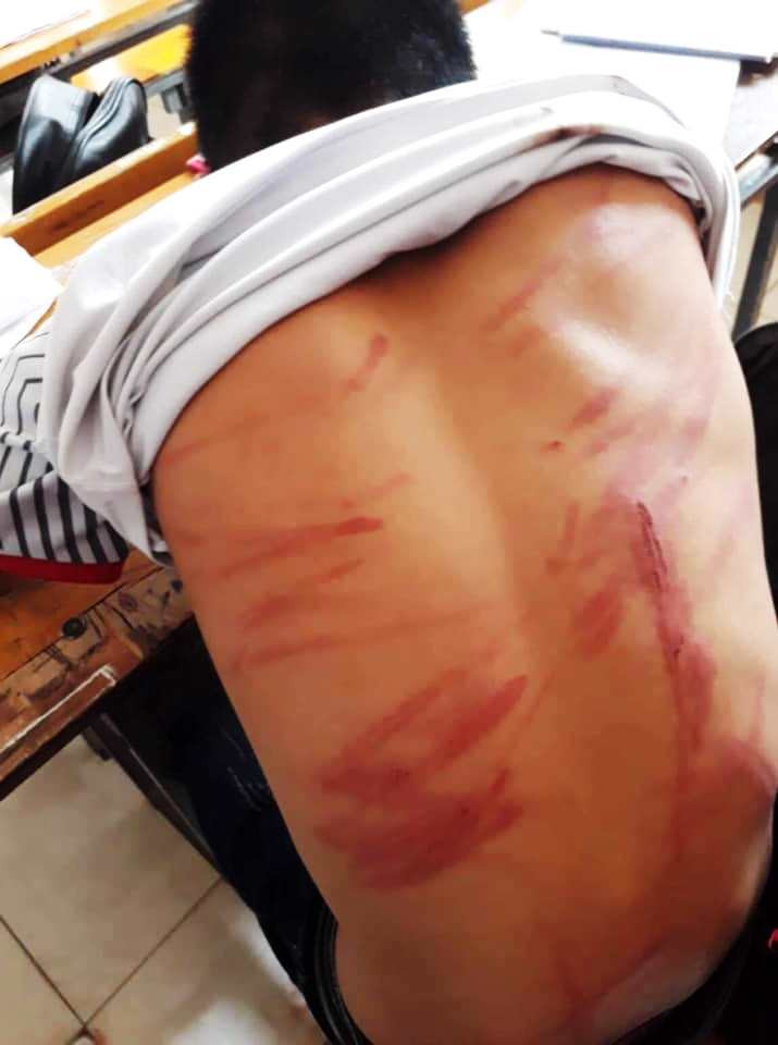 Những vết lằn khắp cơ thể L. Những vết lằn khắp cơ thể L.