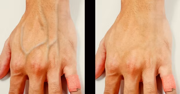 Vì sao có những người da nổi gân xanh rõ rệt hơn bình thường? 2