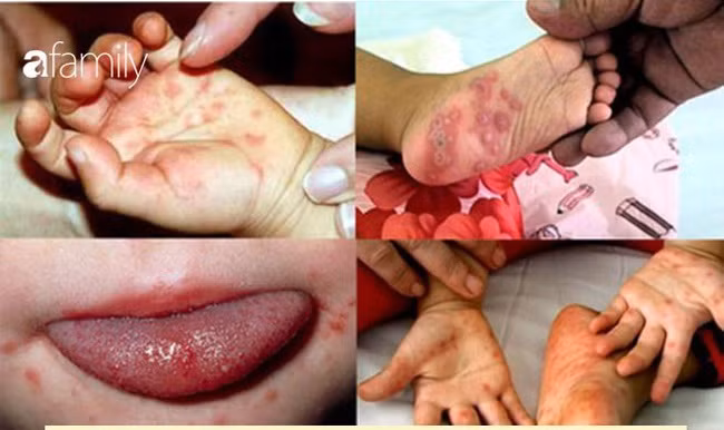 Những việc cha mẹ nên làm ngay để phòng bệnh tay chân miệng cho con