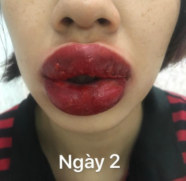 Giật mình đôi môi sưng vù đến méo miệng, nổi mụn chi chít sau khi phun xăm gần nhà ảnh 4