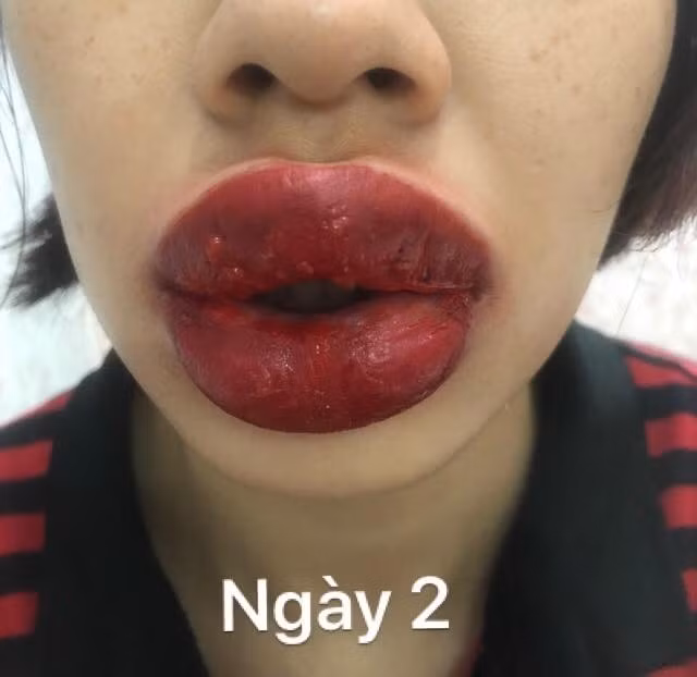Giật mình đôi môi sưng vù đến méo miệng, nổi mụn chi chít sau khi phun xăm gần nhà ảnh 4