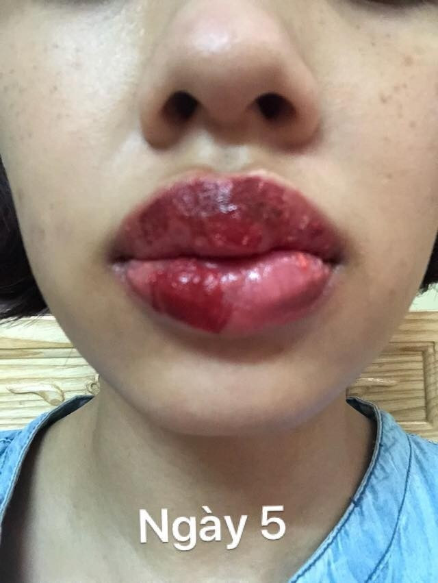 Giật mình đôi môi sưng vù đến méo miệng, nổi mụn chi chít sau khi phun xăm gần nhà ảnh 6