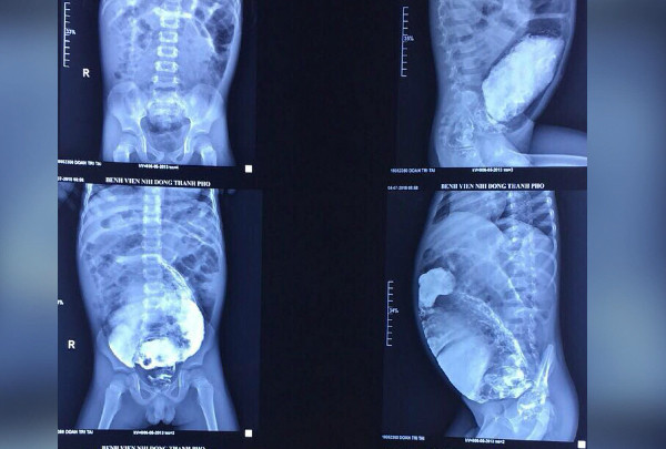 Đại tràng của bé giãn to, ứ đầy phân. Đại tràng của bé giãn to, ứ đầy phân. Ảnh bệnh viện cung cấp.