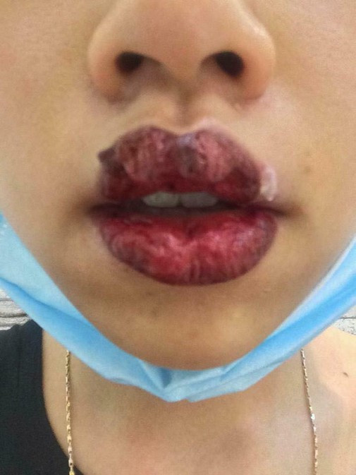 Ham xăm môi căng mọng, cô gái trẻ nước mắt hai hàng nhìn đôi môi sưng tều, cháy sém như quả táo héo - Ảnh 4.