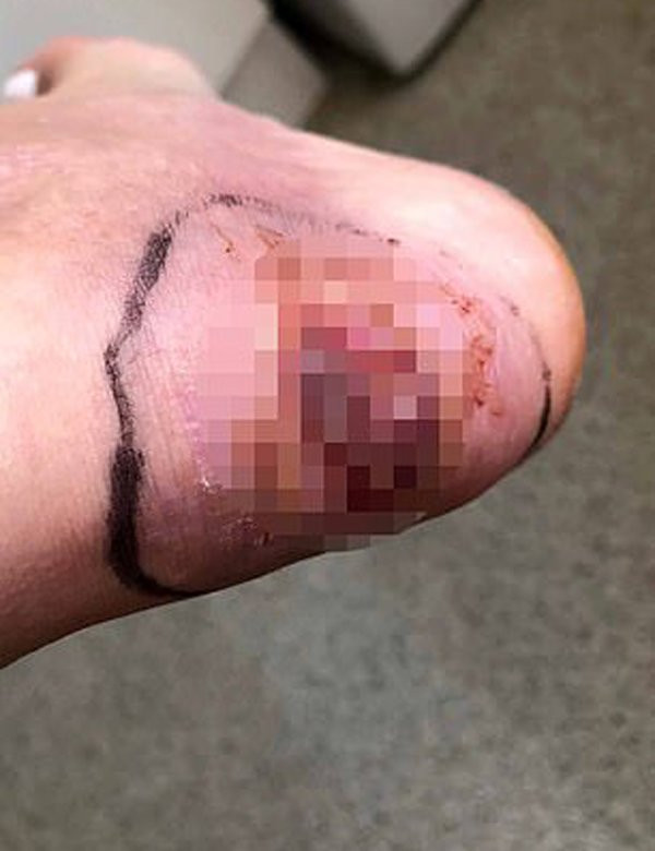 Nữ người mẫu xinh đẹp suýt phải cắt chân vì đi giày có quai hậu ảnh 1 bi thuong khi di giay co quai hau, nu nguoi mau xinh dep suyt phai cat chan - 3