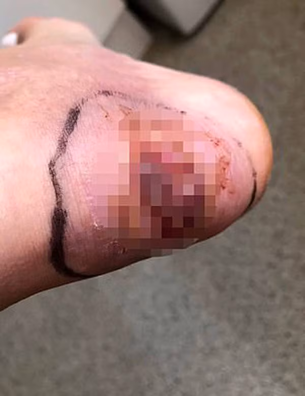 bi thuong khi di giay co quai hau, nu nguoi mau xinh dep suyt phai cat chan - 3