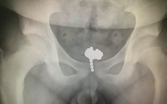 Be trai 11 tuoi nhet 70 vien bi vao 