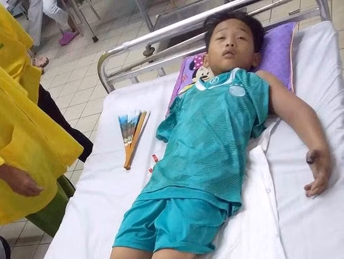 Ra đồng bắt cua cùng bố, bé trai 11 tuổi bị rắn hổ mang cắn nguy kịch