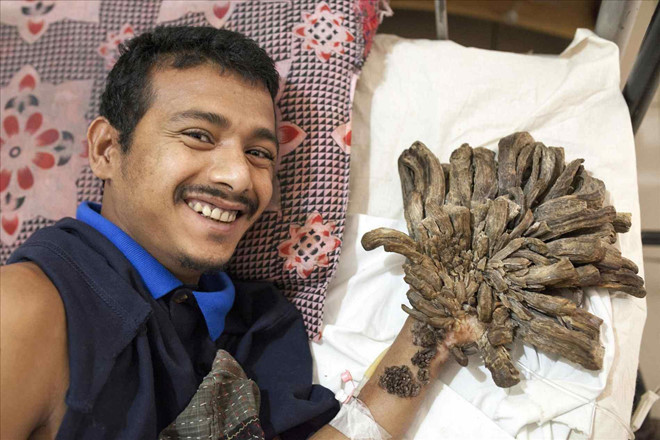 13 năm khốn khổ của “người cây” trước khi xin cắt cụt tay ảnh 2 13 nam khon kho cua