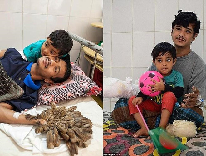 13 năm khốn khổ của “người cây” trước khi xin cắt cụt tay ảnh 8 13 nam khon kho cua