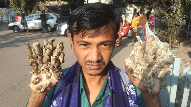 13 năm khốn khổ của “người cây” trước khi xin cắt cụt tay ảnh 5 13 nam khon kho cua