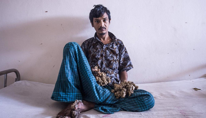 13 năm khốn khổ của “người cây” trước khi xin cắt cụt tay ảnh 10 13 nam khon kho cua