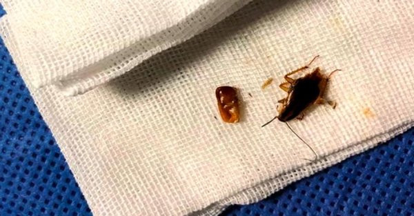 Giật mình thói quen khiến người đàn ông bị cả chục con gián làm tổ trong tai ảnh 1 nguoi dan ong bi ca chuc con gian lam to trong tai vi co thoi quen bua bai nay - 3