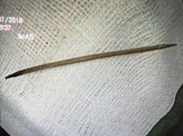 Suýt thủng dạ dày vì nuốt tăm nhiều ngày không biết ảnh 1 Cây tăm nhọn 2 đầu được lấy ra từ dạ dày của người bệnh