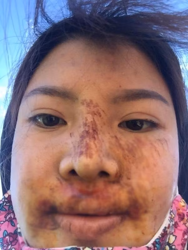 Nhiều người đồn đoán Phượng bị biến chứng sau PTTM.