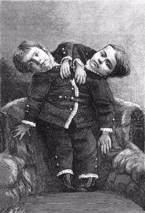 Bí mật phía sai cuộc sống của những cặp song sinh dính liền nhau ảnh 6 Cuộc sống của những cặp song sinh dính liền nhau