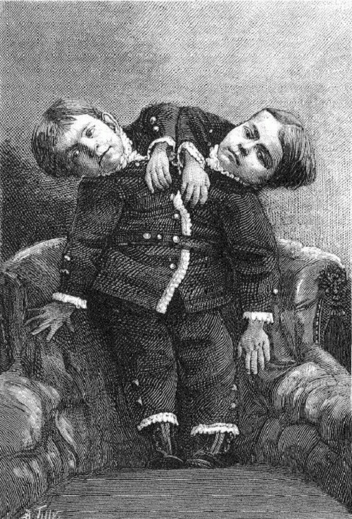 Bí mật phía sai cuộc sống của những cặp song sinh dính liền nhau ảnh 6 Cuộc sống của những cặp song sinh dính liền nhau