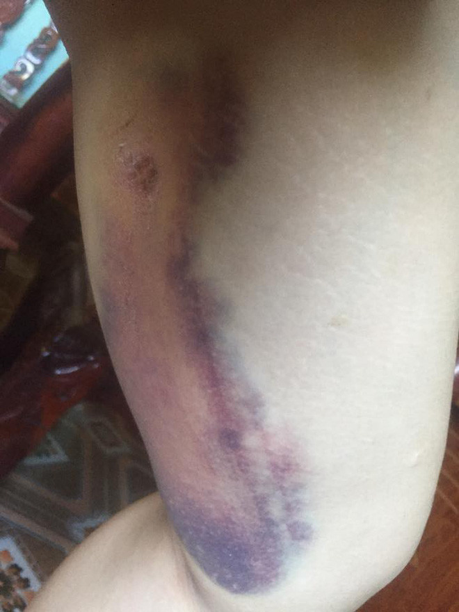 Bị đồn gương mặt biến dạng sau 2 năm PTTM, Thị Nở tái sinh lên tiếng giải thích lí do khiến ai nấy đều ngã ngửa