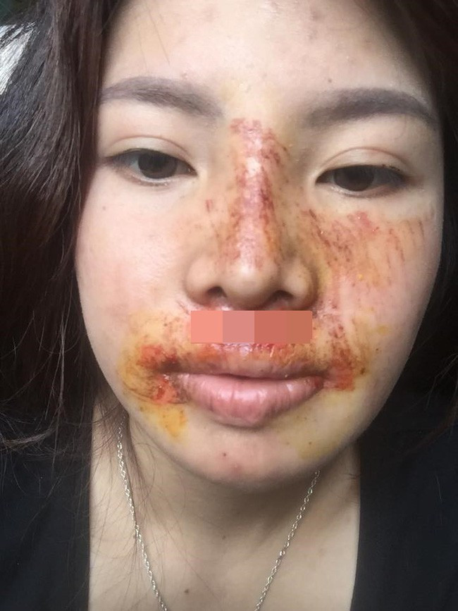 Hình ảnh gương mặt bị trầy xước khiến nhiều người lo lắng.