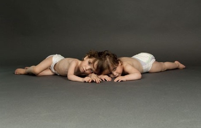 Bí mật phía sai cuộc sống của những cặp song sinh dính liền nhau ảnh 1 Cuộc sống của những cặp song sinh dính liền nhau