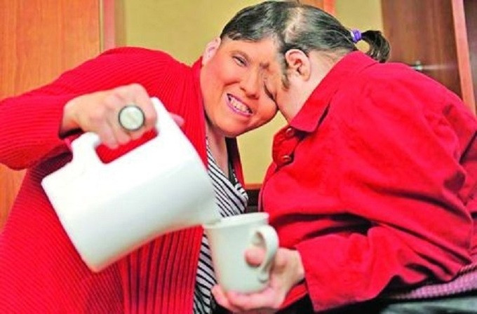 Bí mật phía sai cuộc sống của những cặp song sinh dính liền nhau ảnh 4 Cuộc sống của những cặp song sinh dính liền nhau