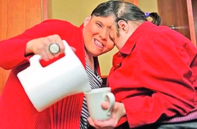 Bí mật phía sai cuộc sống của những cặp song sinh dính liền nhau ảnh 4 Cuộc sống của những cặp song sinh dính liền nhau