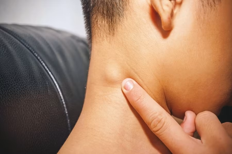 Hạch cổ, một trong những dấu hiệu của bệnh tự miễn. Ảnh: ITN.