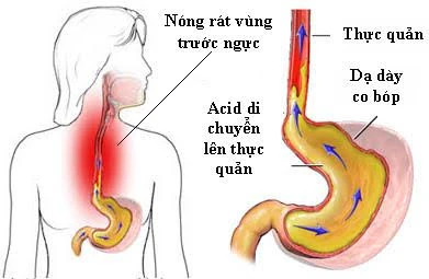 Bị trào ngược dạ dày thực quản? Hãy thử ăn chay