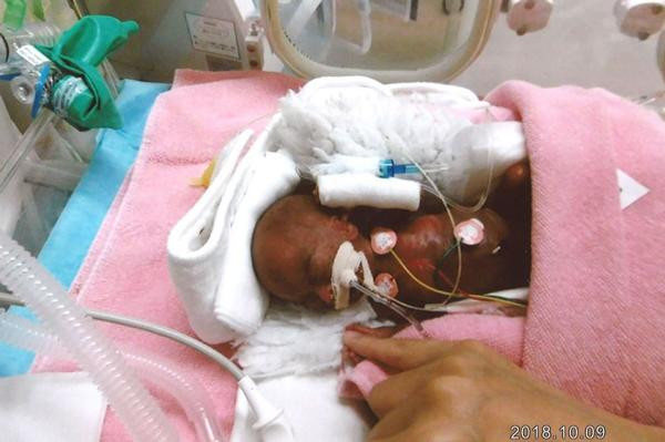 chao doi nang von ven 2,5 lang, cau be song sot nhu ki tich khien ca the gioi tram tro - 1