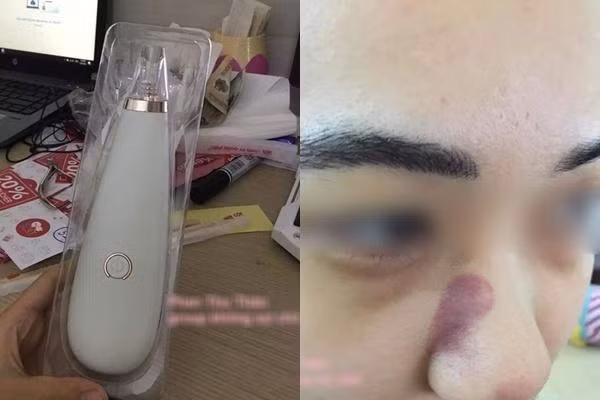 Dùng máy hút mụn cầm tay không đọc kỹ hướng dẫn, cô gái nhận cái kết... không tưởng ảnh 3 "tu xu" mun cung dau voi may hut mun cam tay, co gai nhan cai ket... dang long! - 3