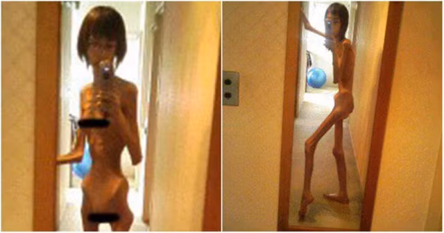 Trước đây, cô gái trẻ trông giống hệt một “bộ xương di động”