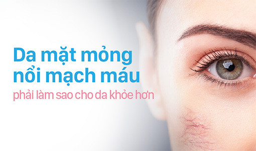 Da mỏng nổi mạch máu cần đặc biệt lưu ý khi chăm sóc da. 