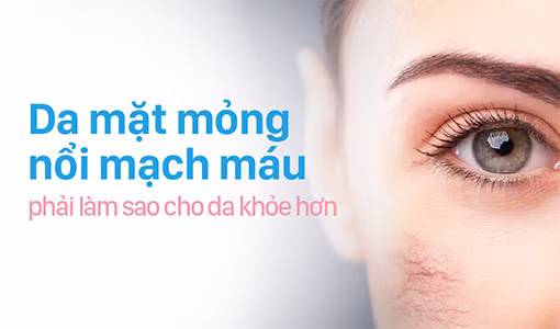 Da mỏng nổi mạch máu cần đặc biệt lưu ý khi chăm sóc da. 
