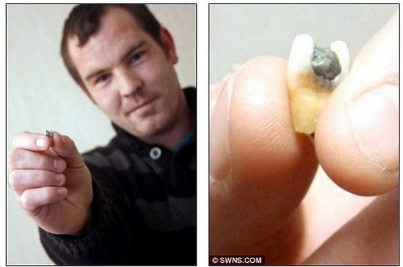 Giật mình phát hiện chiếc răng người bên trong miếng xúc xích 1 Giật mình phát hiện chiếc răng người bên trong miếng xúc xích 1