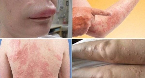 Một vài biến chứng nguy hiểm của bệnh nổi mề đay: