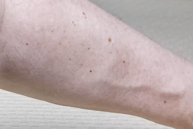 Quá nhiều nốt ruồi ở cánh tay phải có nguy cơ ung thư da.