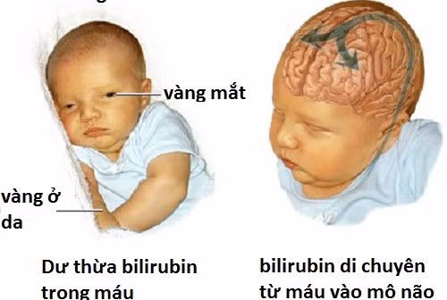 Vàng da sơ sinh là bệnh lý tương đối phổ biến.