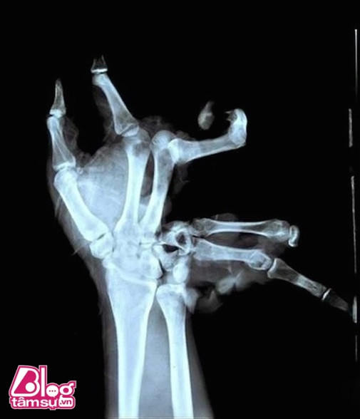 Những khoảnh khắc đáng sợ của các vận động viên thể thao ảnh 3 vdv-blogtamsuvn11