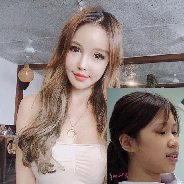 Hot girl số 1 của quốc đảo sư tử lộ ảnh trước khi phẫu thuật thẩm mỹ hình ảnh 4 hot girl so 1 cua quoc dao su tu lo anh truoc khi phau thuat tham my hinh anh 4