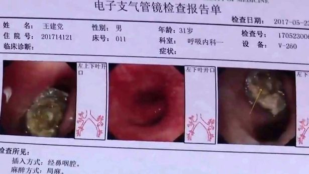 Tìm thấy nắp bút biến dạng kẹt trong phổi gần hai thế kỷ ảnh 1 Tìm thấy nắp bút biến dạng kẹt trong phổi gần hai thế kỷ ảnh 1