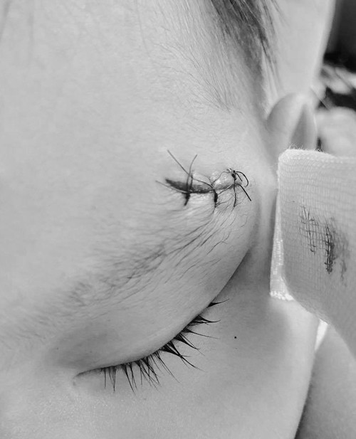 Vết thương khá rộng khiến bé Mio phải khâu 3 mũi. Mỗi ngày, Minh Hà phải đưa con vào viện thay băng và sau 7 ngày bé sẽ được cắt chỉ.