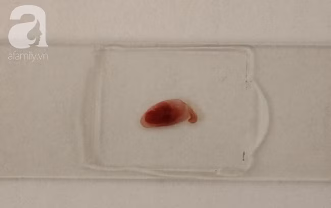 Phát hiện ổ sán dây lợn khiến ít nhất 108 người nhiễm bệnh: Nhiễm sán dây lợn nguy hiểm thế nào? - Ảnh 4.